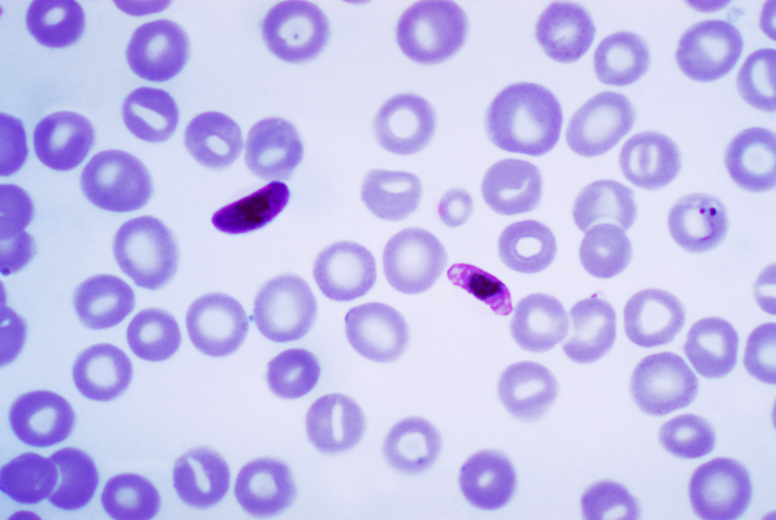 So sehen Plasmodien, die Erreger der Malaria, unter dem Mikroskop aus (Blutausstrich mit Plasmodium falciparum-Zellen in dunkelviolett).