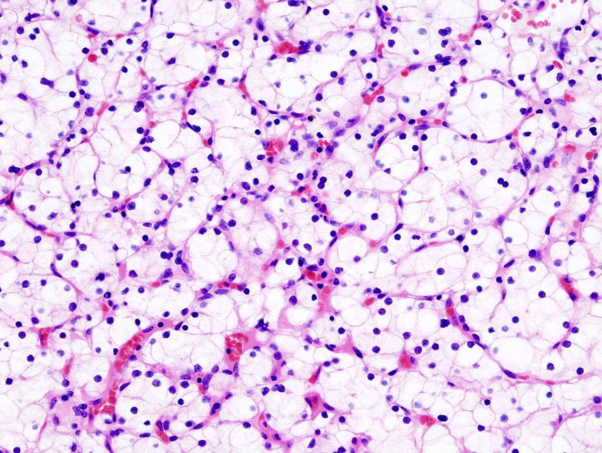 Nierenkrebszellen: Bösartige Tumorerkrankung der Niere sind meistens sogenannte Nierenzellkarzinome. (Bildquelle: © KGH/wikimedia.org/ CC BY-SA 3.0)